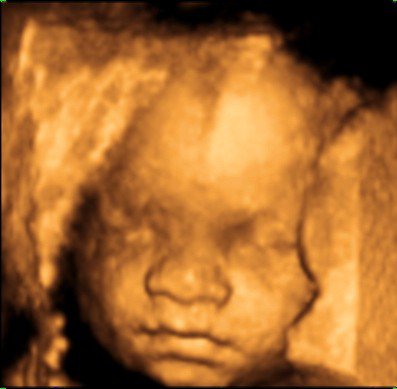 Ecografía 5D en Ciudad Real y Toledo Ginequalitas Reproducción Ecografía 5D