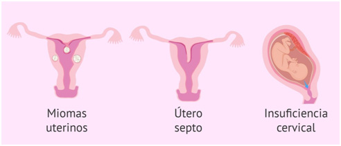 miomas uterinos
